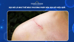 sẹo đỏ