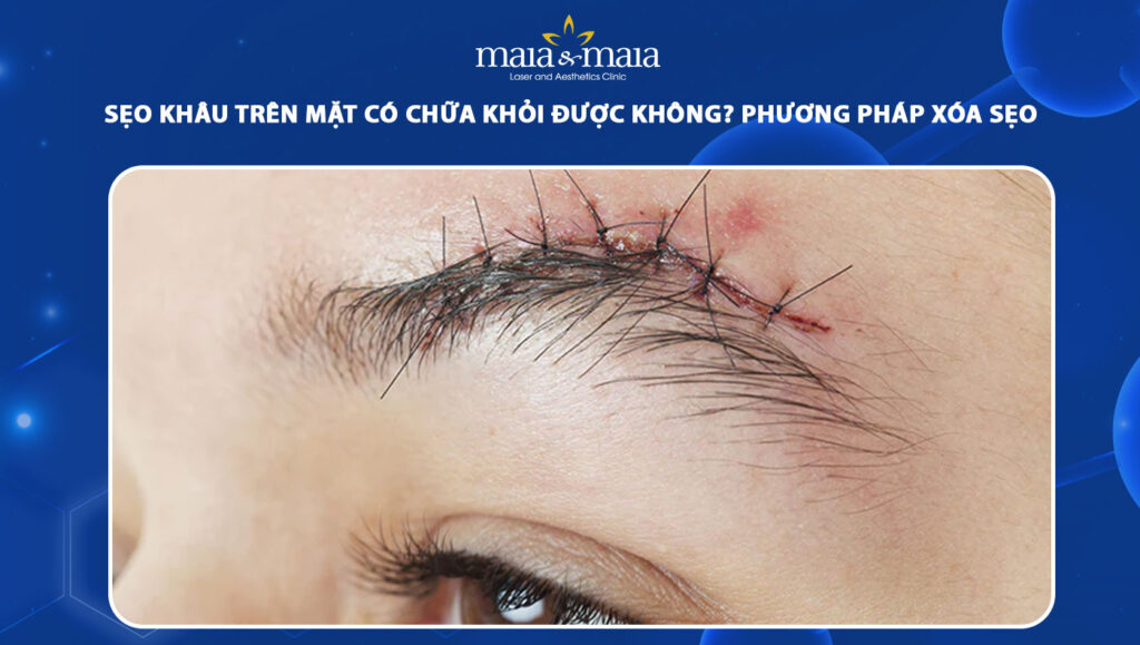 sẹo khâu trên mặt