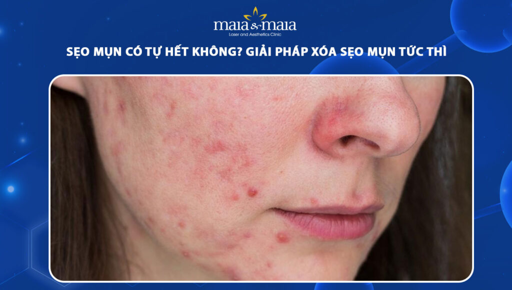 sẹo mụn có tự hết không