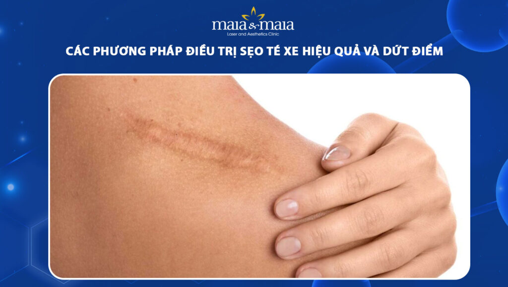 sẹo té xe