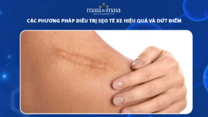 sẹo té xe