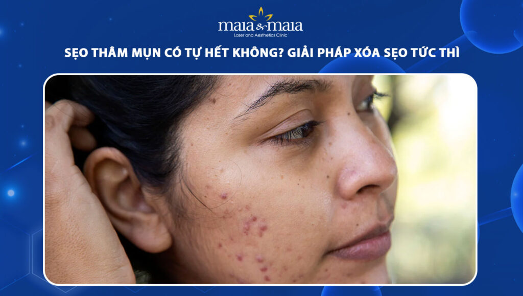 sẹo thâm mụn