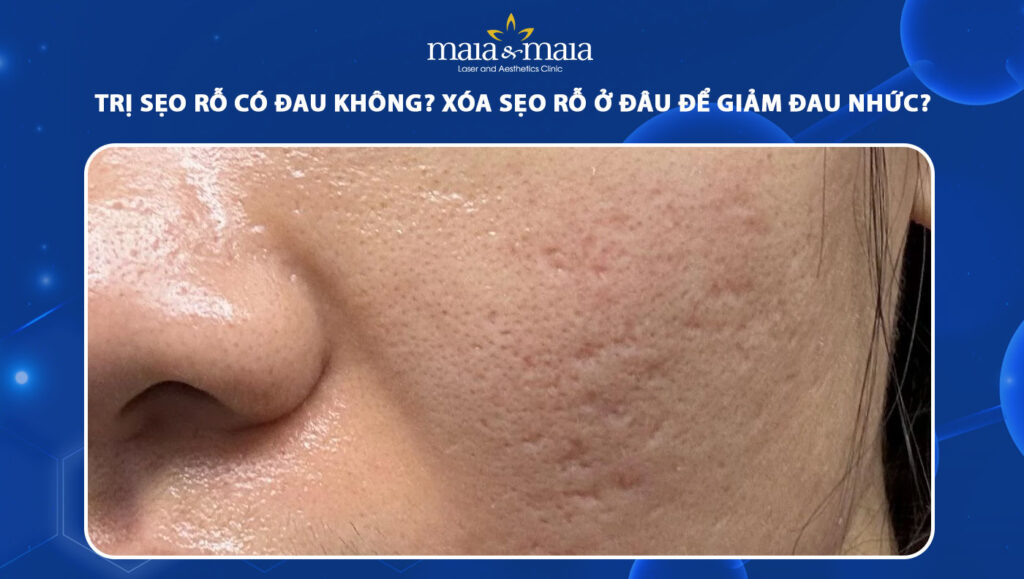 trị sẹo rỗ có đau không