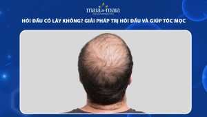 hói đầu có lây không
