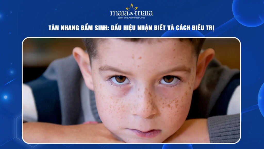 tàn nhang bẩm sinh